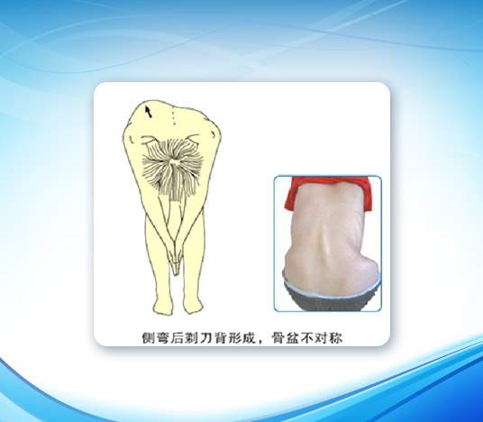 脊柱側彎矯形器-2(圖1)